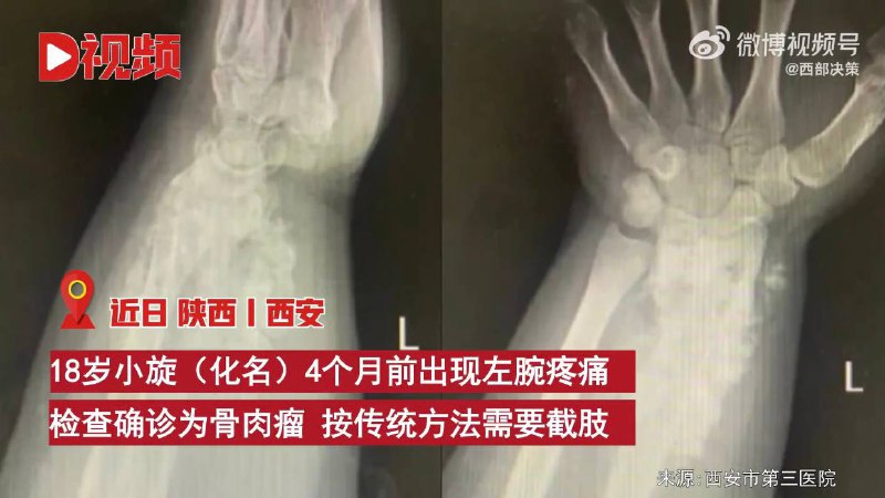 18岁患者左腕疼痛确诊骨肉瘤需截肢，医院用3D打印保住患者左手